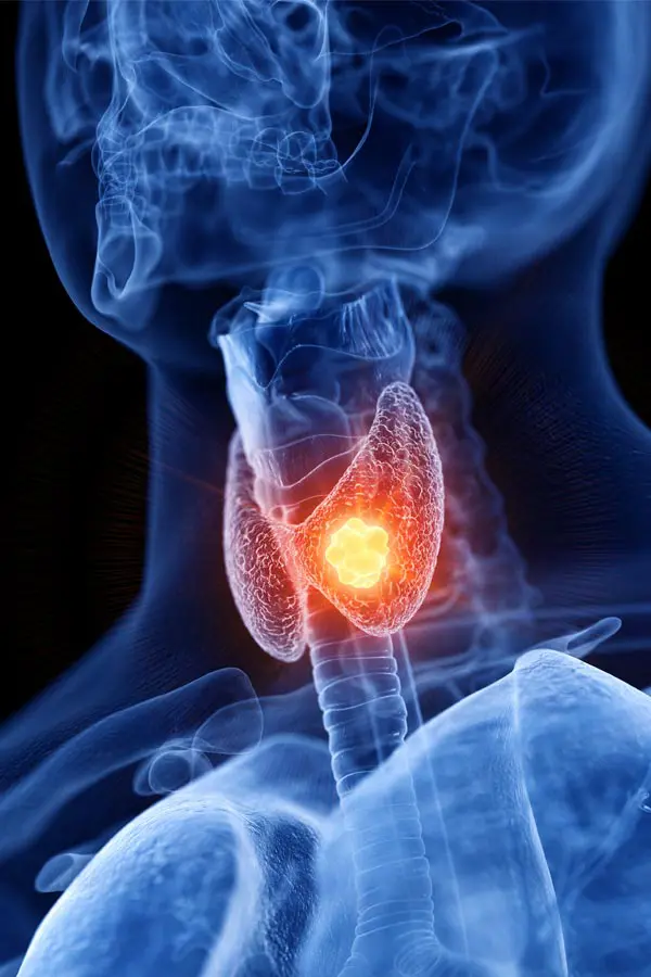 Thyroid-Imbalance-Treatment A 3D illustration of an x-ray of a human neck, highlighting the thyroid. Get help with thyroid imbalance from Fonthealth in Niagara.
